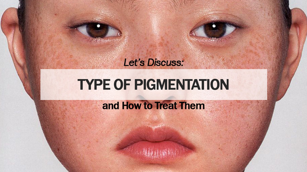 Type of pigmentation and How to treat them